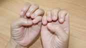 Triệu chứng, nguyên nhân, cách điều trị nấm móng tay