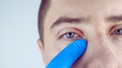 Biện pháp điều trị viêm bờ mi mắt đơn giản, hiệu quả tại nhà