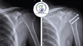 Nghệ An: Phẫu thuật kết hợp xương cho bệnh nhân bị gãy mấu động lớn xương cánh tay