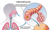 Người bị viêm phế quản nên ăn gì