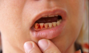 Chảy máu chân răng là dấu hiệu của bệnh gì