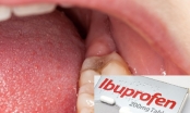 Sưng mộng răng uống Ibuprofen được không