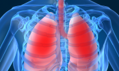 Ung thư phổi sống được bao lâu ?