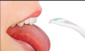 Tê lưỡi là dấu hiệu bệnh gì?