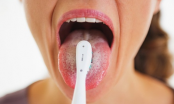 Rát lưỡi là dấu hiệu của bệnh gì?