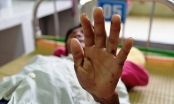 Một học sinh tử vong do mắc hội chứng viêm da dày sừng lòng bàn tay bàn chân