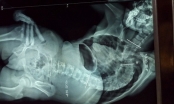 Phẫu thuật chỉnh thành công cột sống ngực bị vẹo nặng cho bé gái 12 tuổi