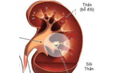 Cách chữa sỏi thận bằng các bài thuốc dân gian