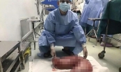 Phẫu thuật cắt đại tràng nặng 13kg cho bệnh nhân bị táo bón suốt 20 năm