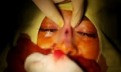 Cô gái thủng mũi sau phẫu thuật nâng mũi
