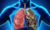 Thời gian ủ bệnh ung thư phổi bao lâu?