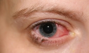Đau mắt đỏ dùng thuốc gì hiệu quả nhất?