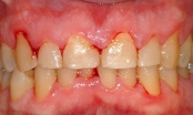 Chảy máu chân răng hôi miệng là dấu hiệu bệnh gì?