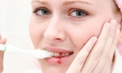 Chảy máu chân răng khi đánh răng phải làm sao?