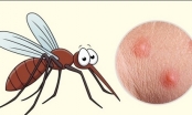 Muỗi đốt nổi mụn nước có nguy hiểm không?