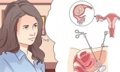Phẫu thuật thai ngoài tử cung bao lâu thì khỏi?