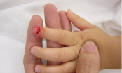 Cách sơ cứu khi trẻ bị dập ngón tay, ngón chân