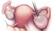 Phẫu thuật u nang buồng trứng bao lâu thì khỏi?