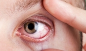 Các bệnh về mắt thường gặp nhất