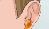 Viêm tai giữa có mủ chữa như thế nào?
