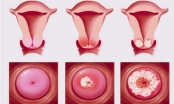 Viêm âm đạo ở phụ nữ là bệnh gì?