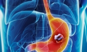 Ung thư hang vị là gì và ung thư hang vị sống được bao lâu?