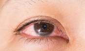 Cách trị đau mắt đỏ bằng thuốc nam cực hiệu quả