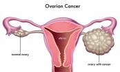 Những điều cần biết về ung thư buồng trứng