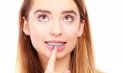 Bị sâu răng có nên niềng răng không?