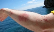 Vì sao đi biển về da bị ngứa và nổi mẩn đỏ?
