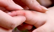 3 dấu hiệu cảnh báo bệnh tay chân miệng nặng hơn ở trẻ em