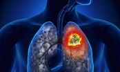 Thông tin bệnh ung thư phổi