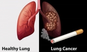 Người có 6 thói quen này có tỉ lệ mắc ung thư phổi rất cao