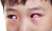 Mùa mưa lũ trẻ rất dễ đau mắt đỏ, cha mẹ nên biết cách phòng tránh và điều trị bệnh