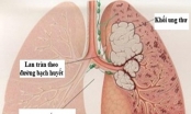 Dấu hiệu sớm của ung thư phổi không nên bỏ qua