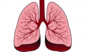 Làm sao để phát hiện ung thư phổi sớm?