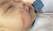 Trẻ bị bỏng nặng do mẹ bất cẩn nhỏ nhầm axit vào mũi