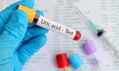Chỉ số acid uric trong máu cao nguyên nhân và giải pháp điều trị