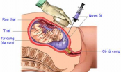Chỉ số nước ối tuần 29 như thế nào?