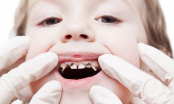 Vì sao trẻ dễ bị sâu răng, nguyên nhân và cách chăm sóc trẻ bị sâu răng