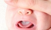 Nấm miệng là bệnh gì? Và cách chăm sóc trẻ bị nấm miệng như thế nào?