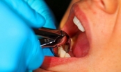Bệnh nhân 65 tuổi ở Bắc Ninh nguy kịch sau khi nhổ răng số 8