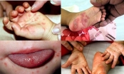 Đã có 10 trẻ mắc tay chân miệng biến chứng nặng, dương tính với EV71