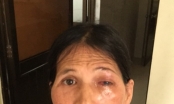 Đắp thuốc lá chữa đau mắt, một phụ nữ suýt bị thủng giác mạc