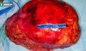 Ung thư tế bào mỡ: Những người có lớp mỡ bụng dày thật sự rất đáng lo ngại!