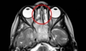Bé 3 tuổi chảy mũi liên tục tưởng viêm xoang, ngờ đâu mắc ung thư hiếm