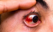 Tụ máu trong mắt có nguy hiểm không?