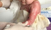 Bé gái 4 tuổi bị bỏng toàn thân khi tắm