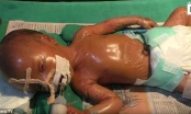 Em bé mắc hội chứng “da ni lông” chào đời ở Ấn Độ
