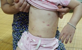 Phú Thọ: Bé gái 42 tháng tuổi bị nhiễm trùng nặng do thủy đậu